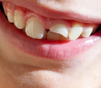 Kırık Diş Doktoru Ankara