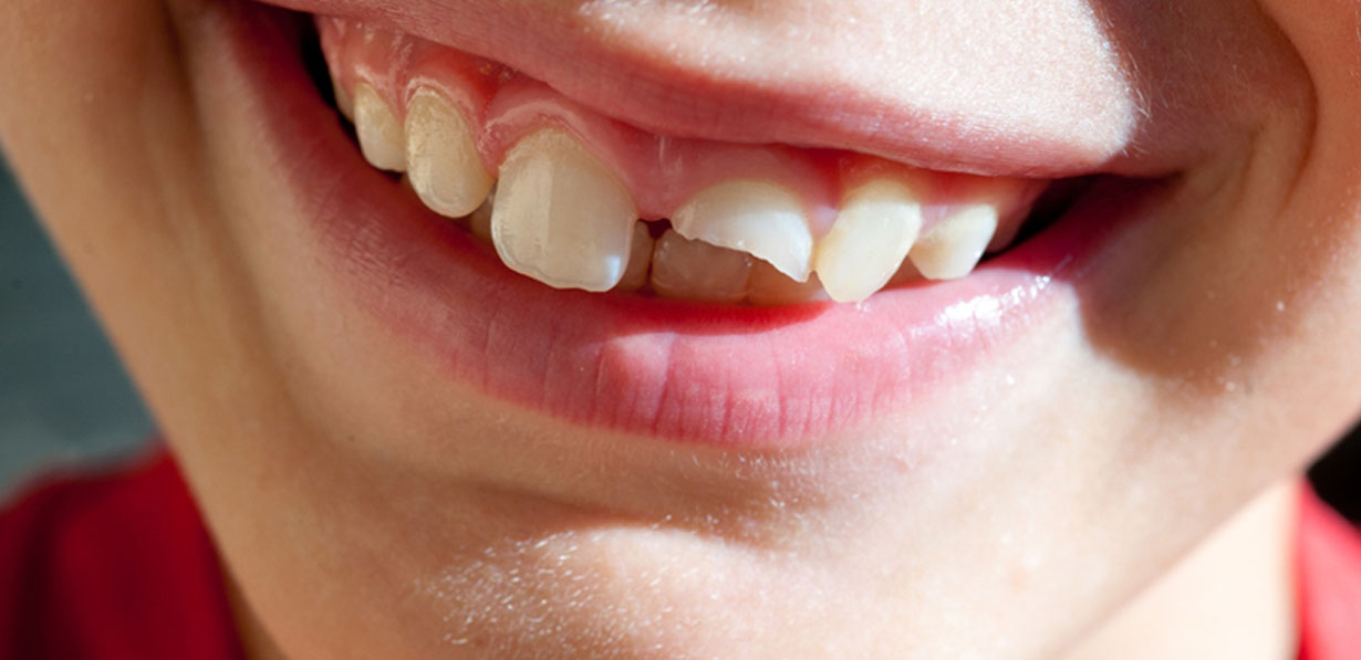 Kırık Diş Doktoru Ankara